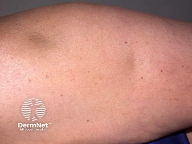 What is lupus erythematosus profundus (LEP)?