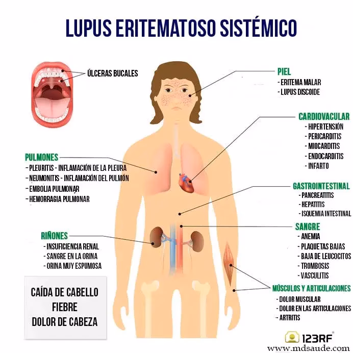 ¿Cómo evitar los síntomas del lupus?