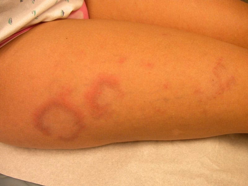 Does lupus erythematosus cause skin rashes?