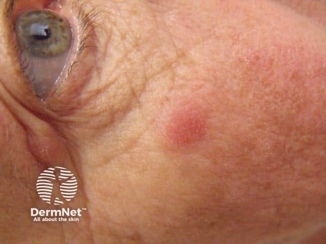 What does Tumid lupus erythematosus look like?