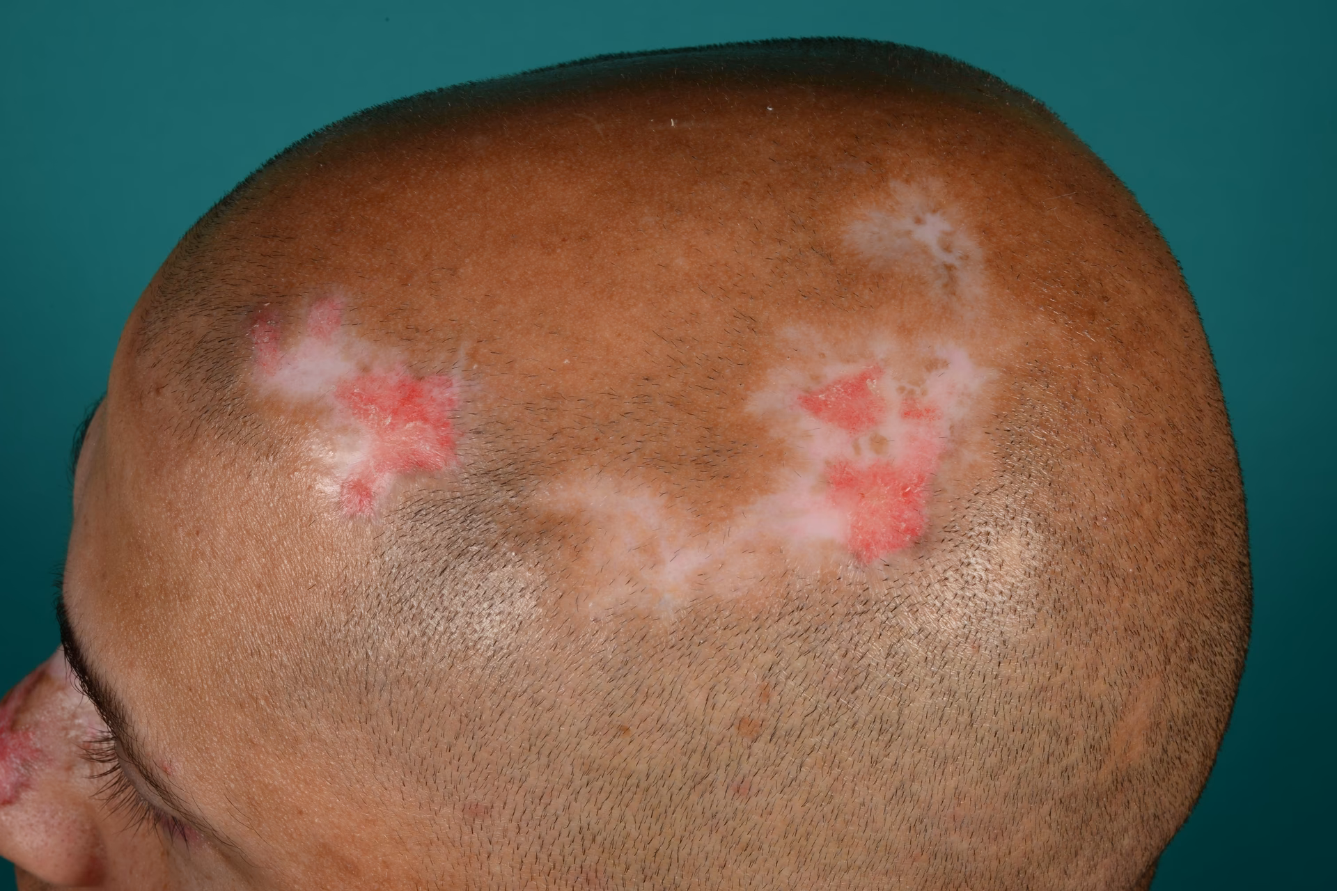 Hvad er lupus erythematosus?