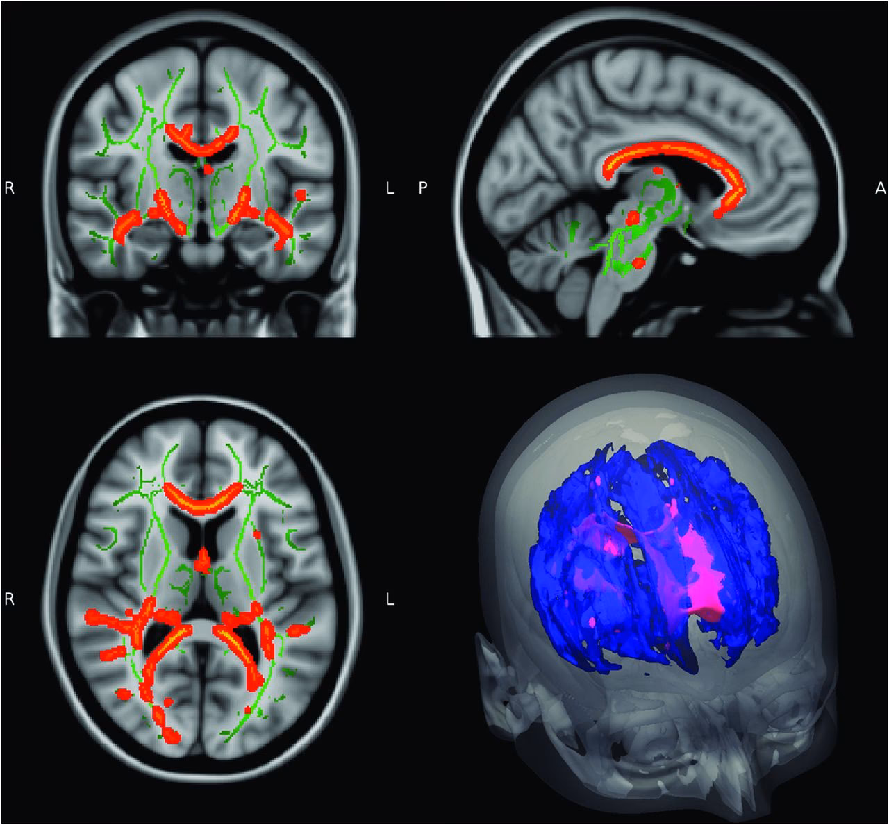 Can you have lupus if you have multiple sclerosis?