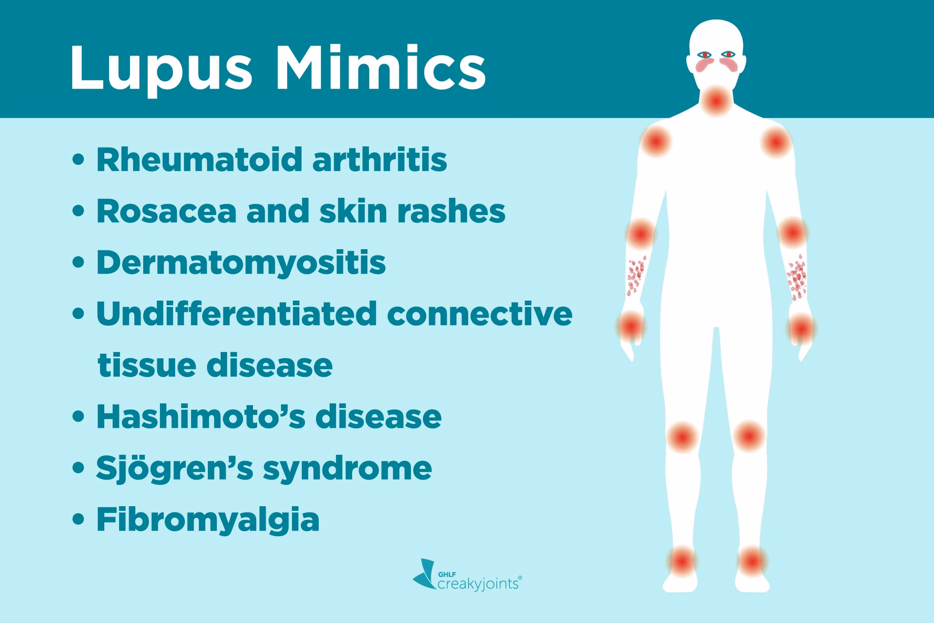 Do lupus symptoms come and go?