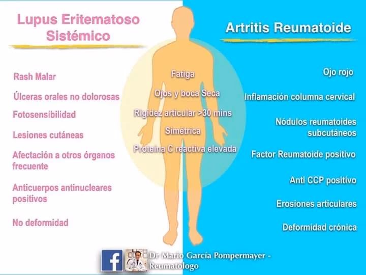 ¿Cómo se trata el lupus?