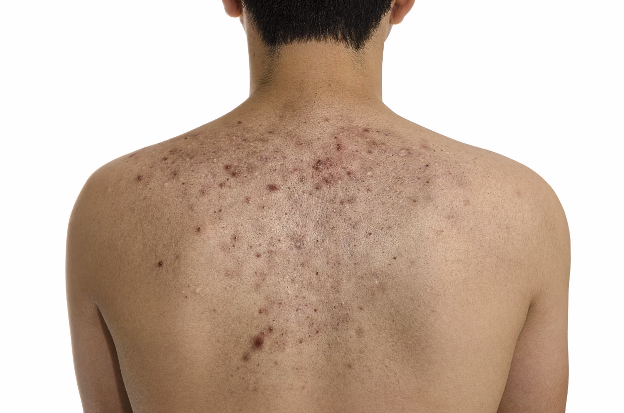 ¿Cómo afecta el lupus a las articulaciones?