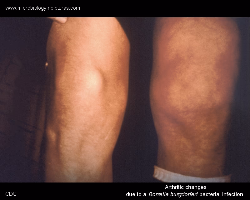 How long does Lyme arthritis last?