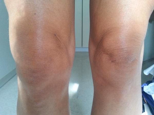 What happens if you don't get treatment for Lyme arthritis?