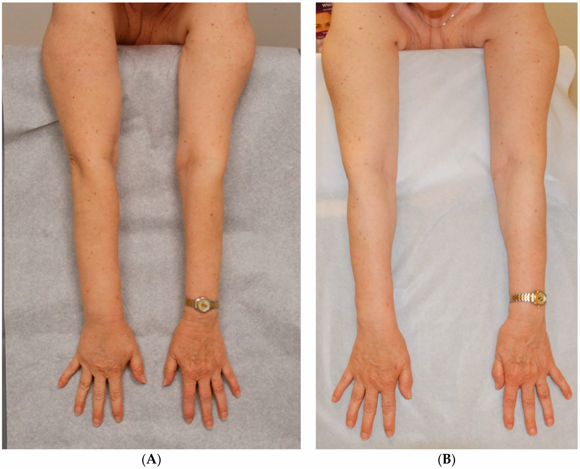 Can lymphoedema be treated with LVA surgery?