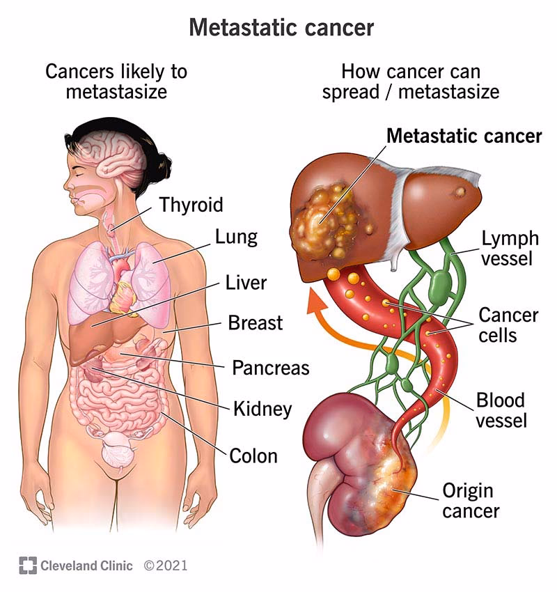 Is MGUS a cancer?