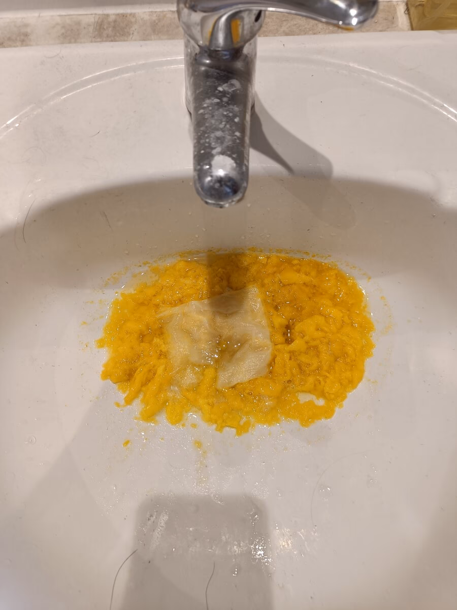 Are bowel problems a complication of multiple sclerosis?