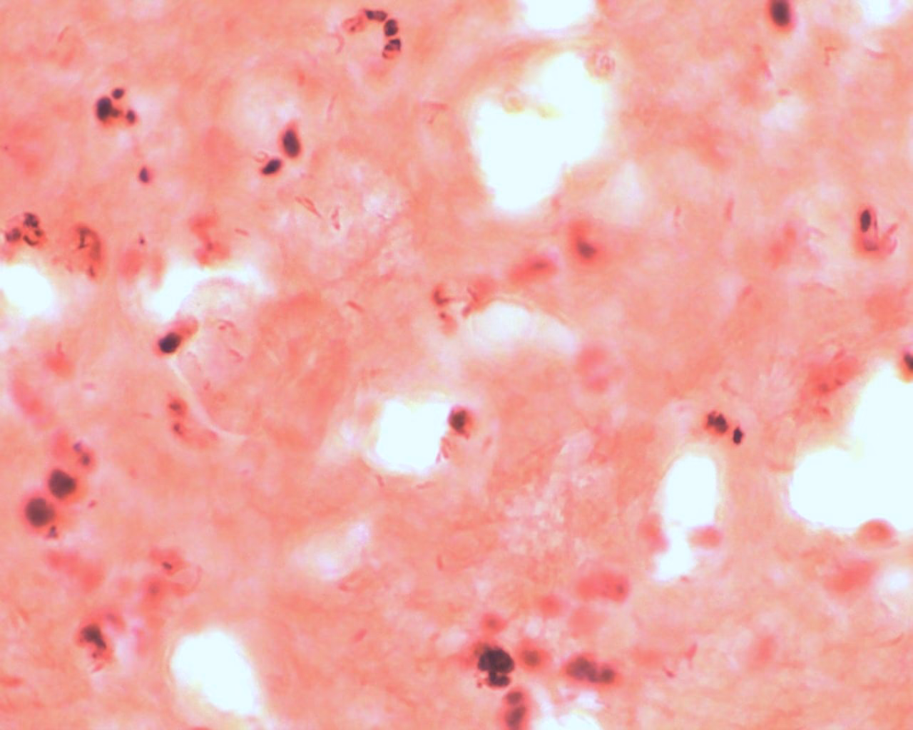 Which stain is used to identify M tuberculosis?