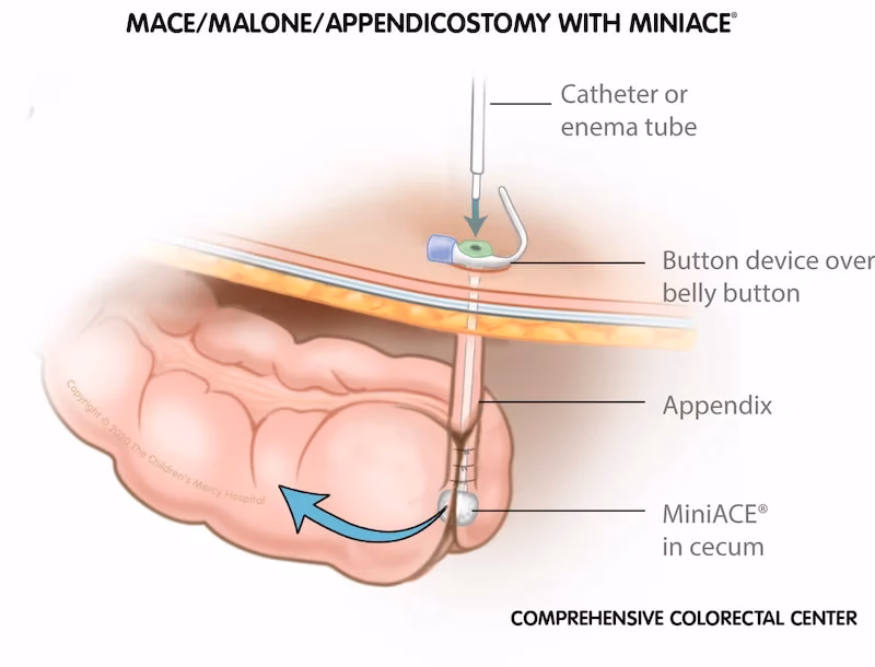 What is a Malone antegrade continence enema?