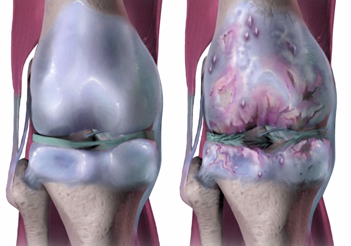 Hvad er et lægemiddel mod slidgigt?
