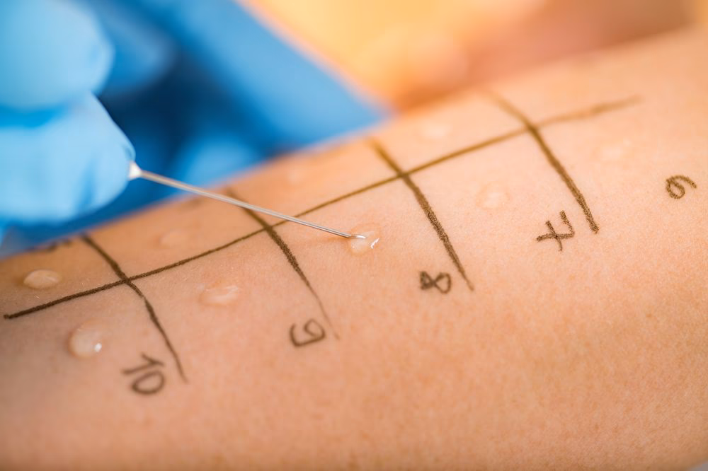 How do doctors diagnose cannabis allergies?