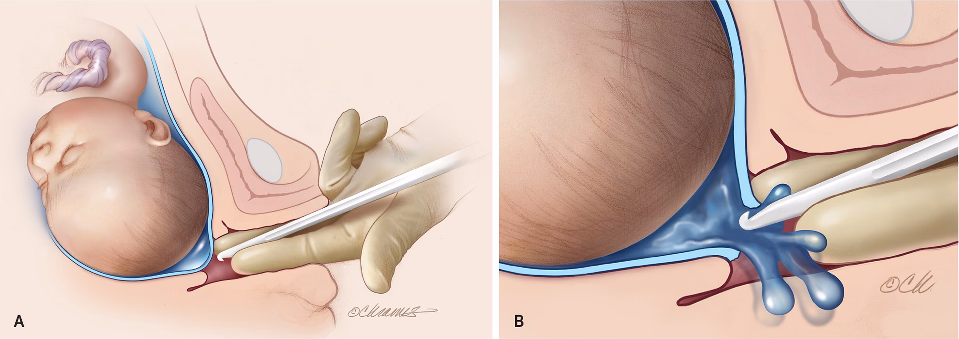 What are simple massage techniques for Labour?