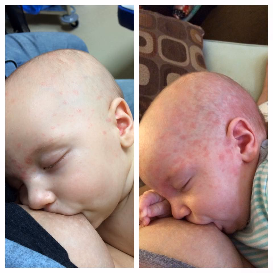 What happens if a child gets measles?