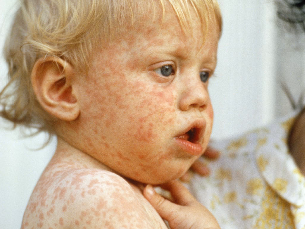 Can babies get measles?