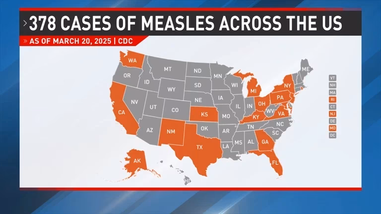 Which states have confirmed measles in 2025?