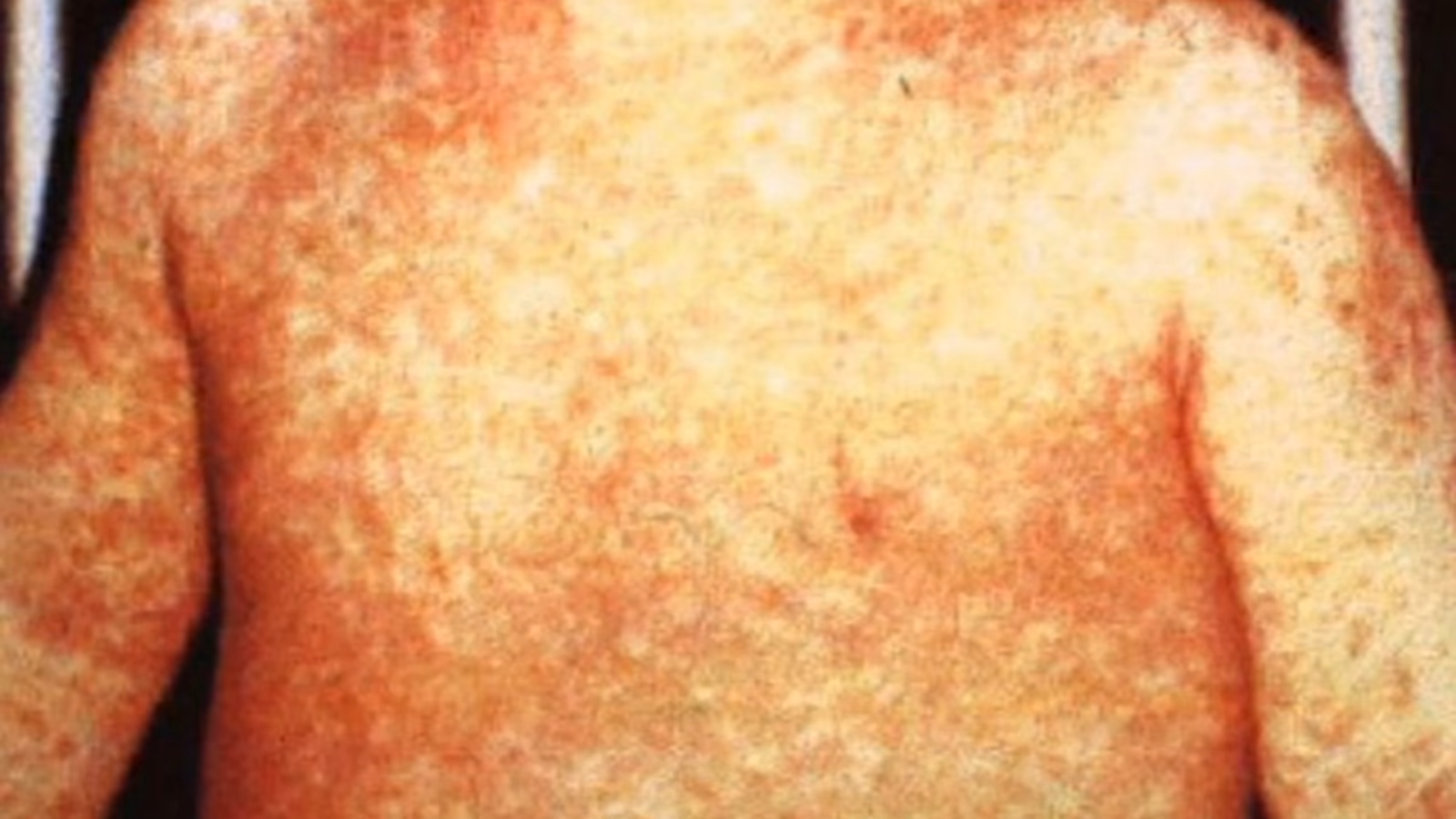 Why are older adults more vulnerable to measles?