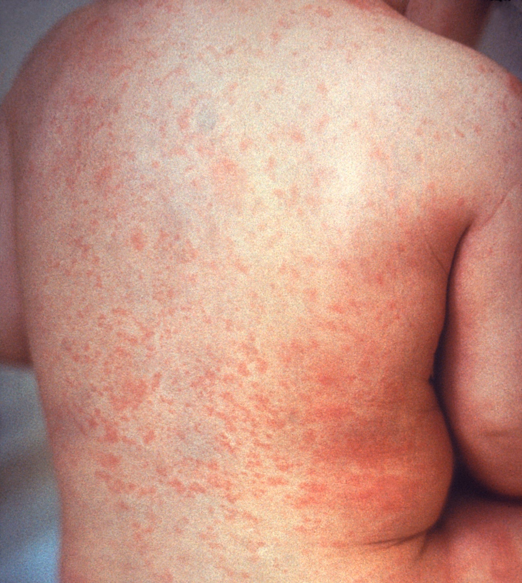 What is a measles outbreak in Texas?