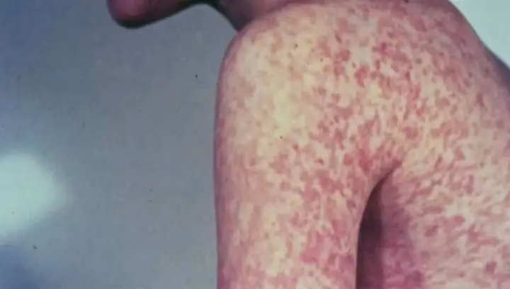 Did you go to Costco if you got measles in Edmonton?