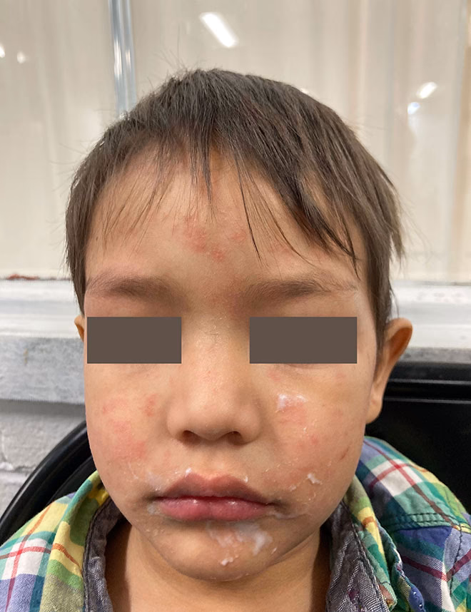 How long does a measles rash last?
