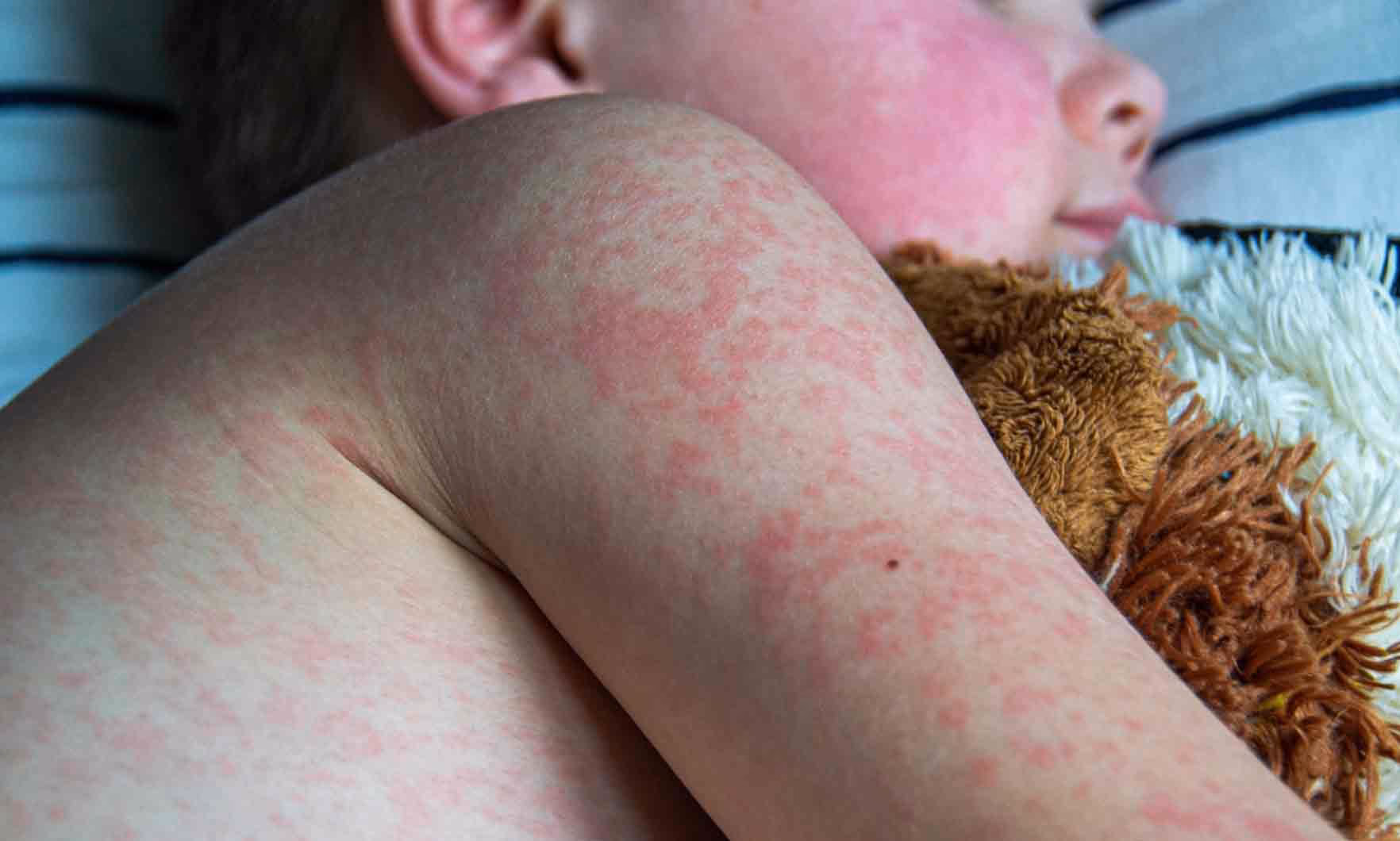 What time is a measles exposure at Guelph Medical Place Pharmacy?