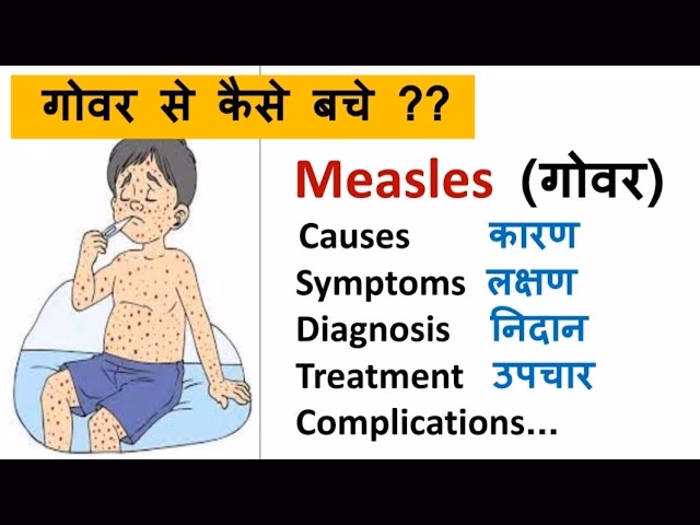 मीजल्स वाइरल को कैसे रोका जा सकता है?