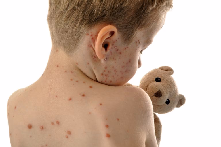 Should you call a health care practitioner if you've been exposed to measles?