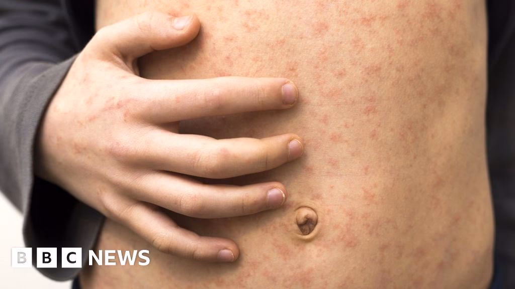 How many measles cases were reported in Northern Ireland in 2024?
