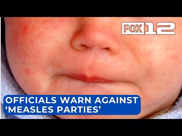 Can a child go to a measles party?
