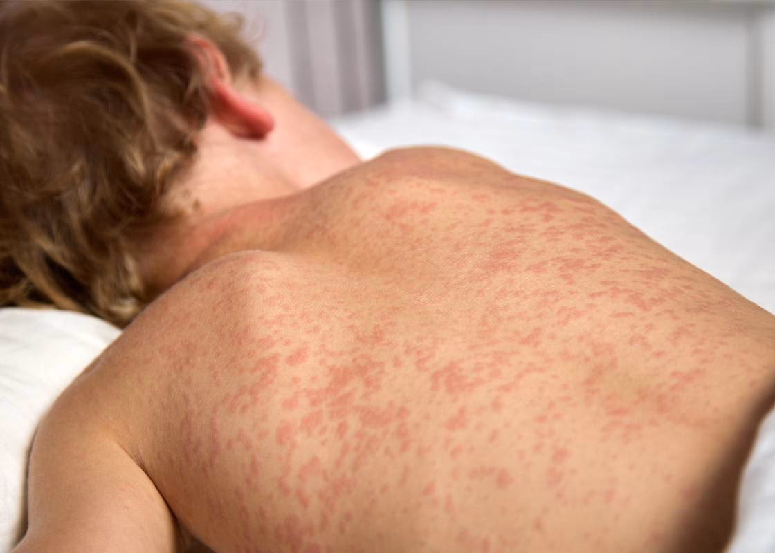 What causes flat red macules in measles?