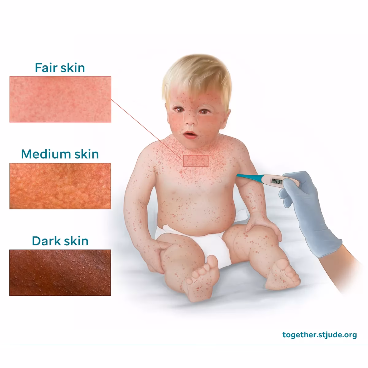 Can a measles rash cause encephalitis?