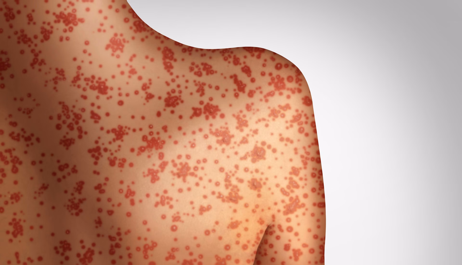 How are new cases assigned to a genotype in measles?