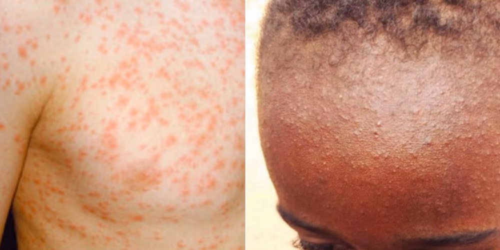 How many laboratory confirmed measles cases are there in England?