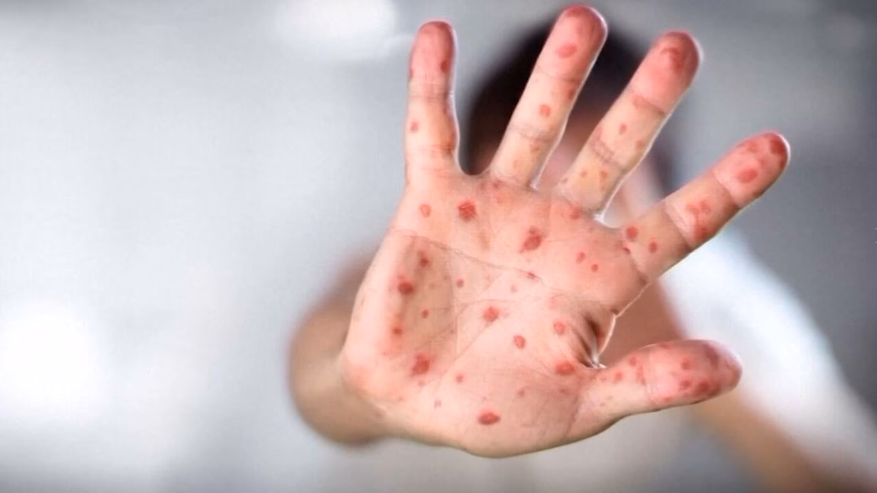 How many cases of measles were confirmed in Oconto County in 2025?