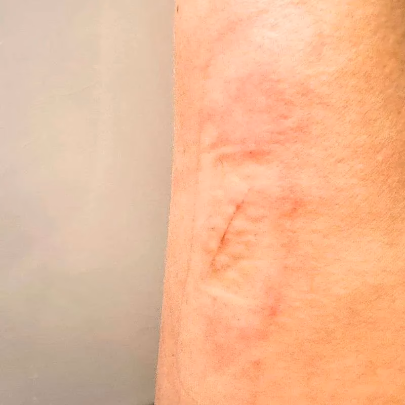 What is tape allergy?