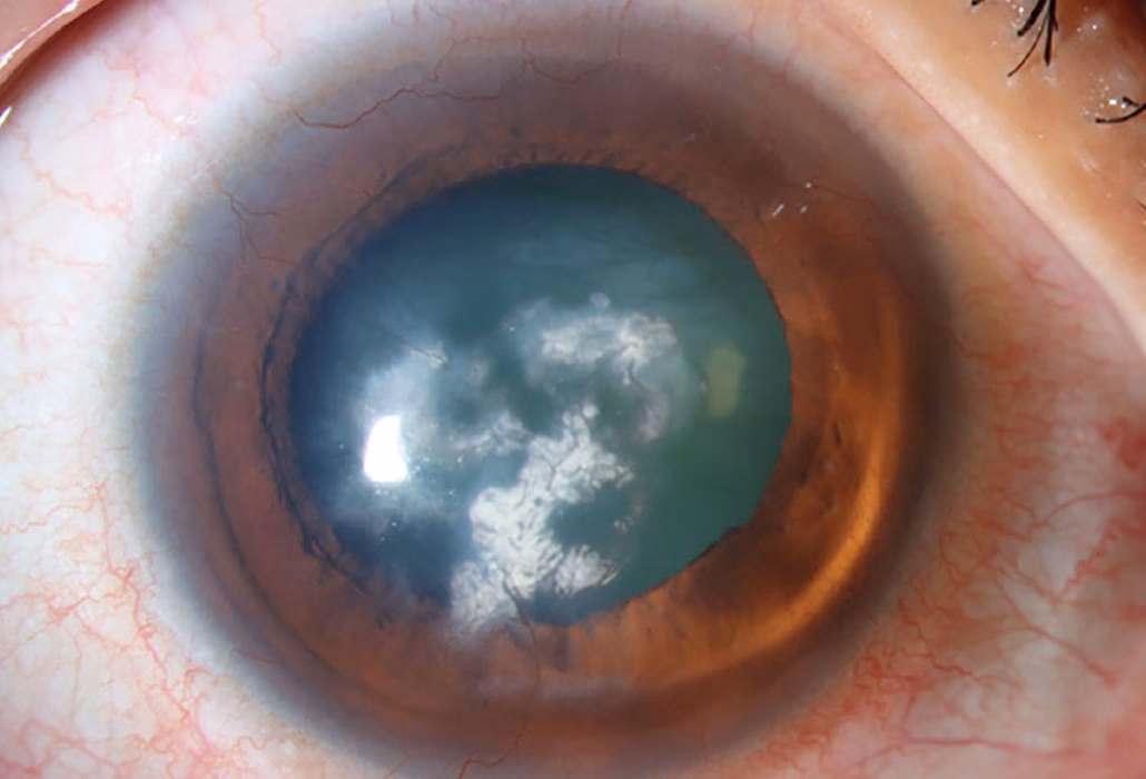 Can drug deposits cause opacity in corneal epithelium?
