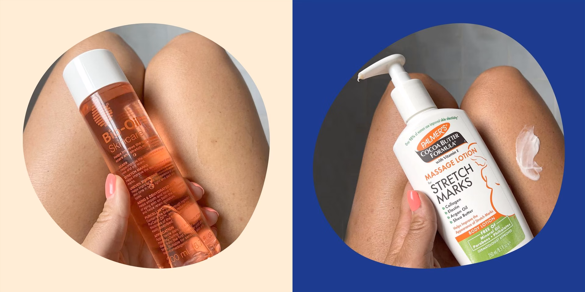 What are the treatment options for stretch marks (striae)?