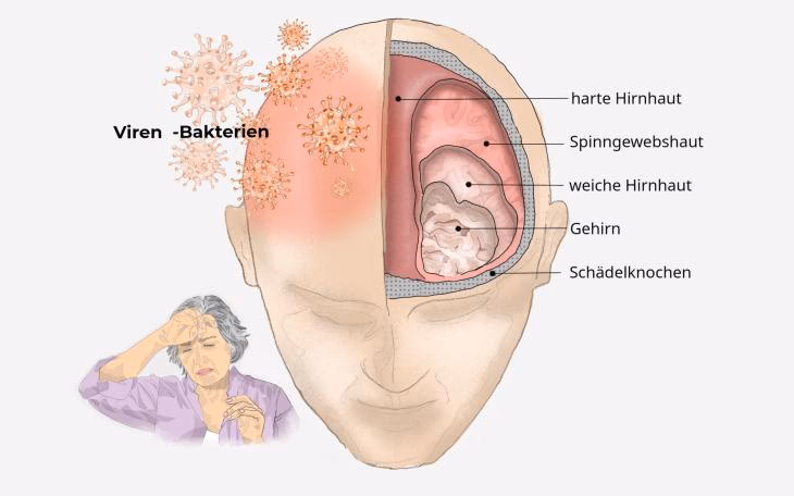 Wie wirkt sich Meningitis auf das Gehirn aus?