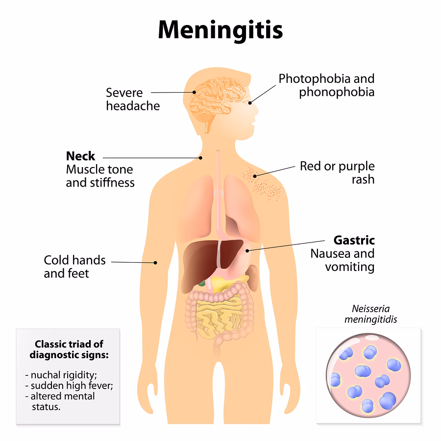 What is bacterial meningitis?
