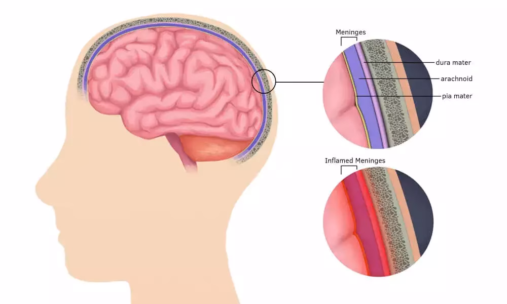 Why is meningitis under-reported in India?