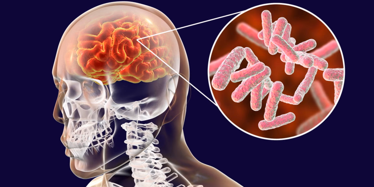 Apa yang harus dilakukan untuk mengendalikan gejala meningitis?