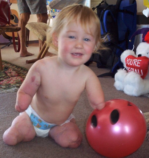 Can meningitis cause limb loss?