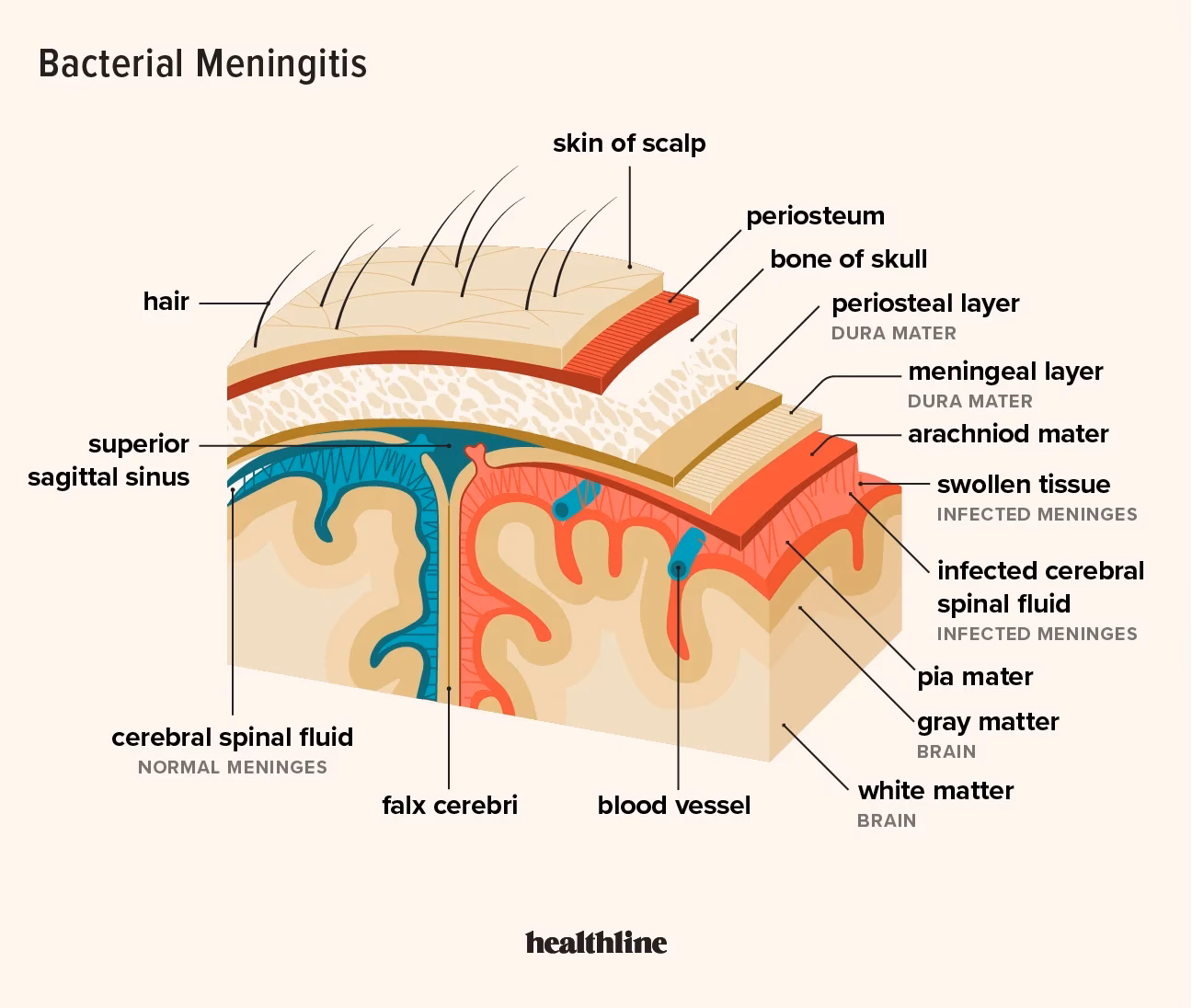How long has meningitis been a part of Our Lives?
