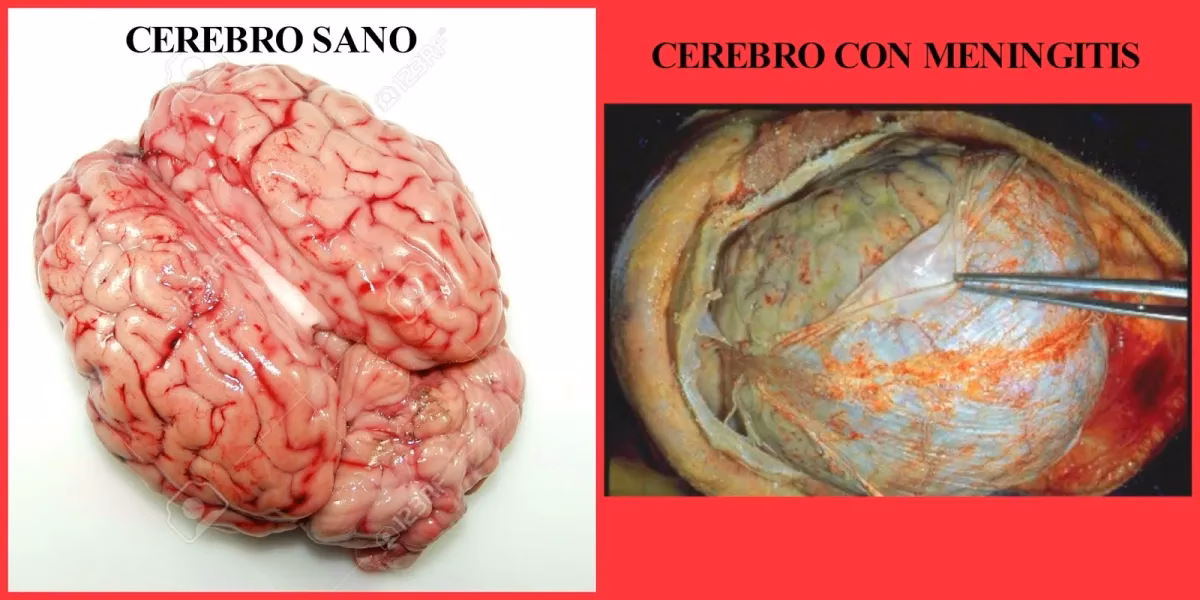 Does tuberculous meningitis cause permanent blindness?