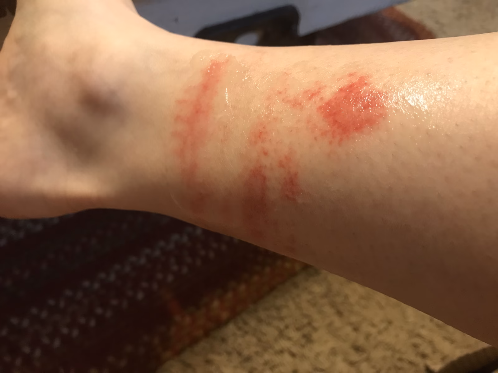 Does Merino cause hives & sneezing?