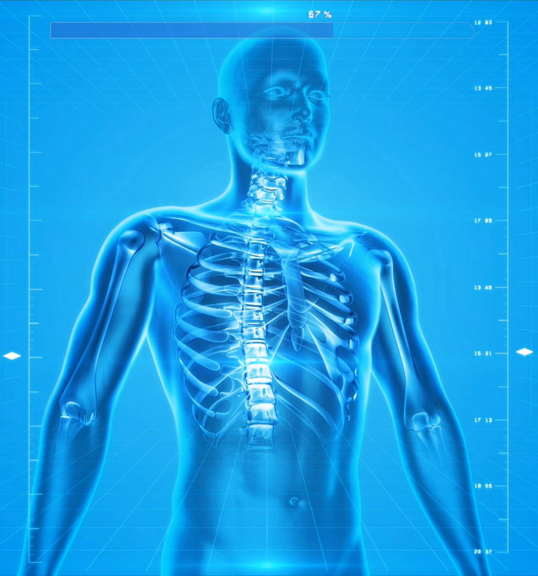 Does PBM help lower limb bone fractures?