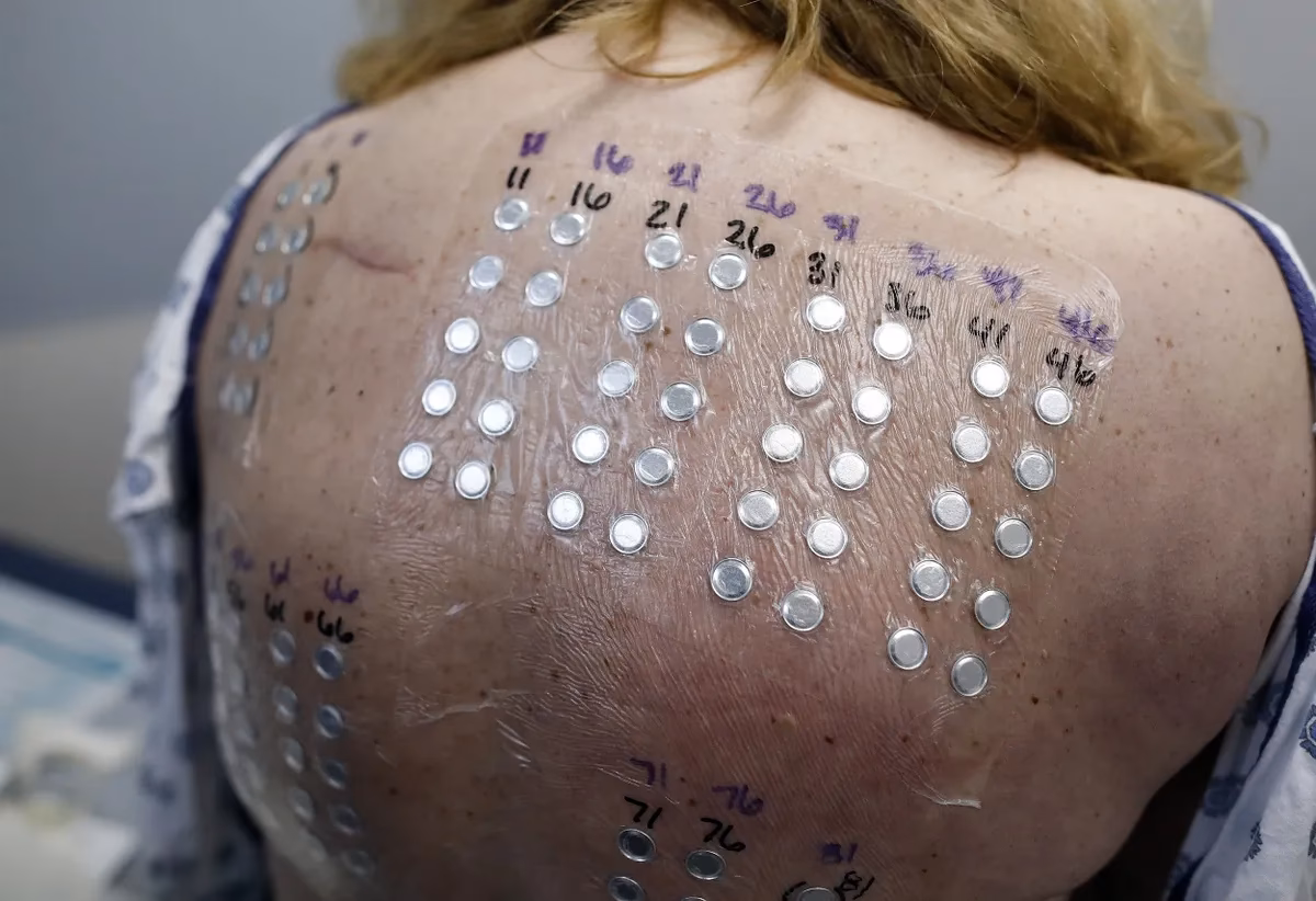 What is skin contact allergy testing?