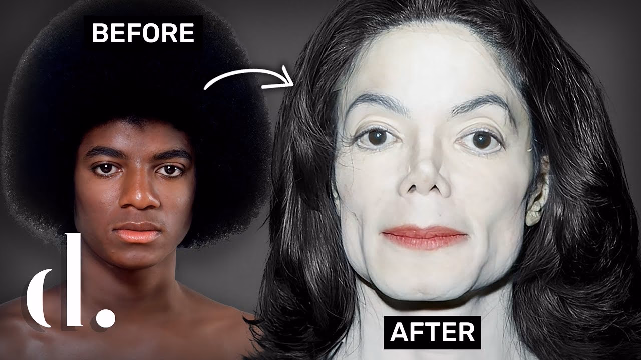 How many surgeries did Michael Jackson have?